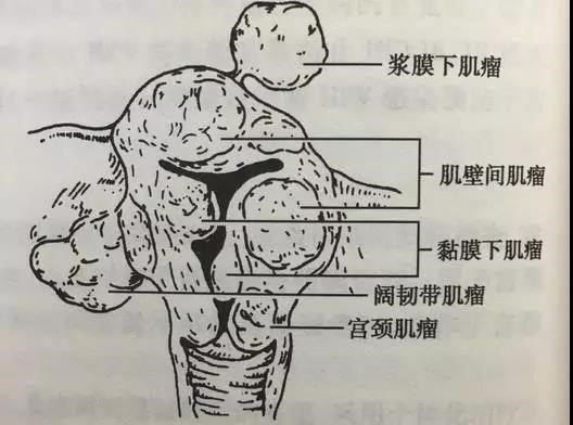 (2)浆膜下肌瘤:肌瘤突出于子宫