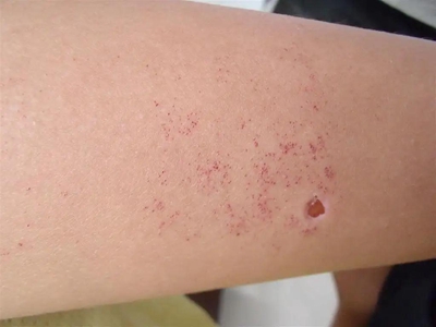 jpeg 匍行性血管瘤胳膊上有密密麻麻的红点图.jpeg