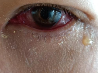 jpeg 眼睑淋病眼睛红肿有分泌物图.jpeg