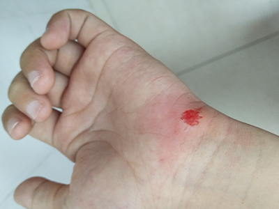 jpg 跌伤手掌根部内侧皮肤擦脱破溃出血图.jpg