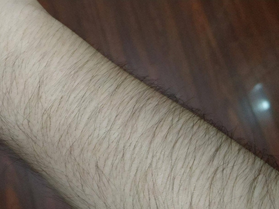 妇女多毛症症状图片