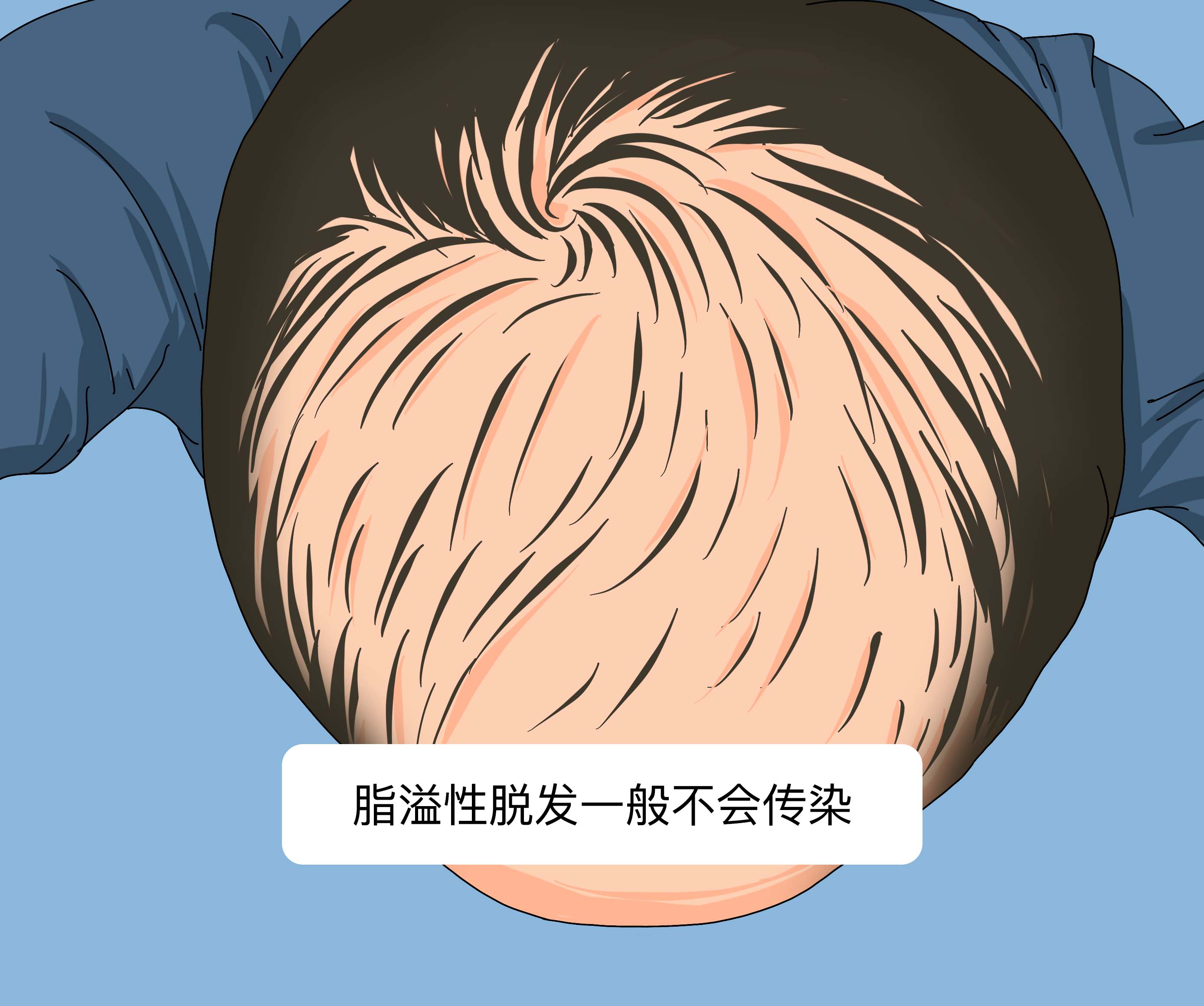 jpg 脂溢性脱发会传染吗.jpg