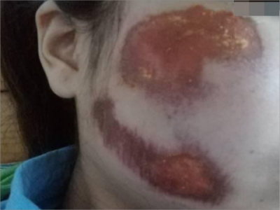 png 擦伤面部有结痂图.png