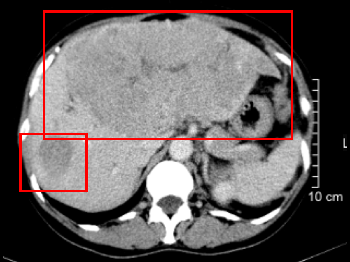 肝惡性腫瘤01.jpg