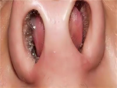 jpeg 鼻中隔血肿鼻子里两侧各有一个红包图.jpeg