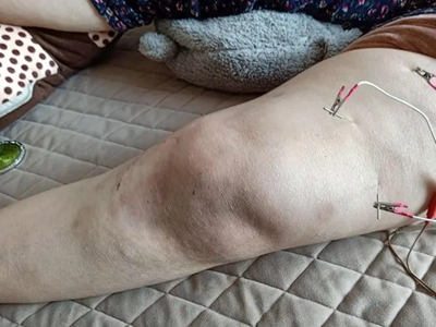 jpg 膝关节创伤性滑膜炎膝盖肿胀变形图.jpg