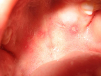 jpeg 口腔手足口病图片.jpeg