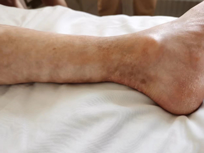 jpg 系统性硬皮病小腿皮肤萎缩变细图.jpg