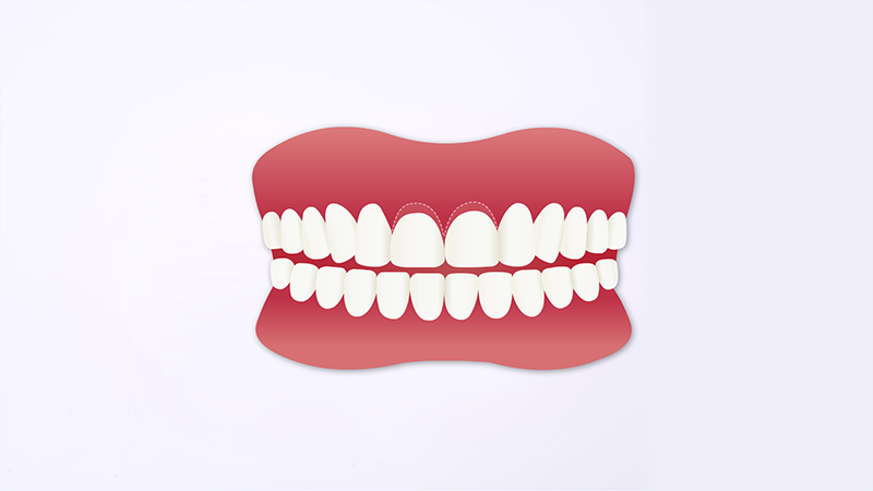 png 切口设计.png