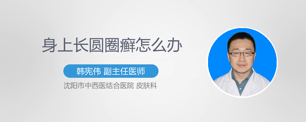 身上长圆圈癣