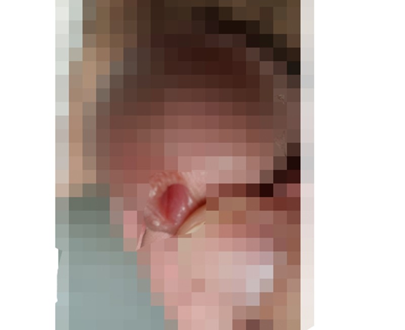 男人得了尿道口尖銳濕疣圖片