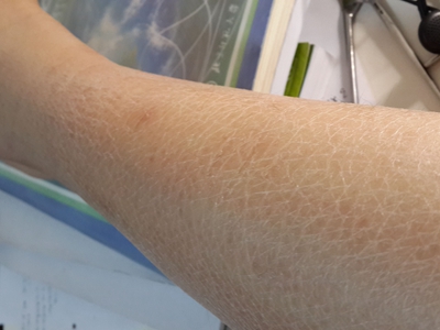 jpg 蛋白质营养不良小腿裂纹图.jpg