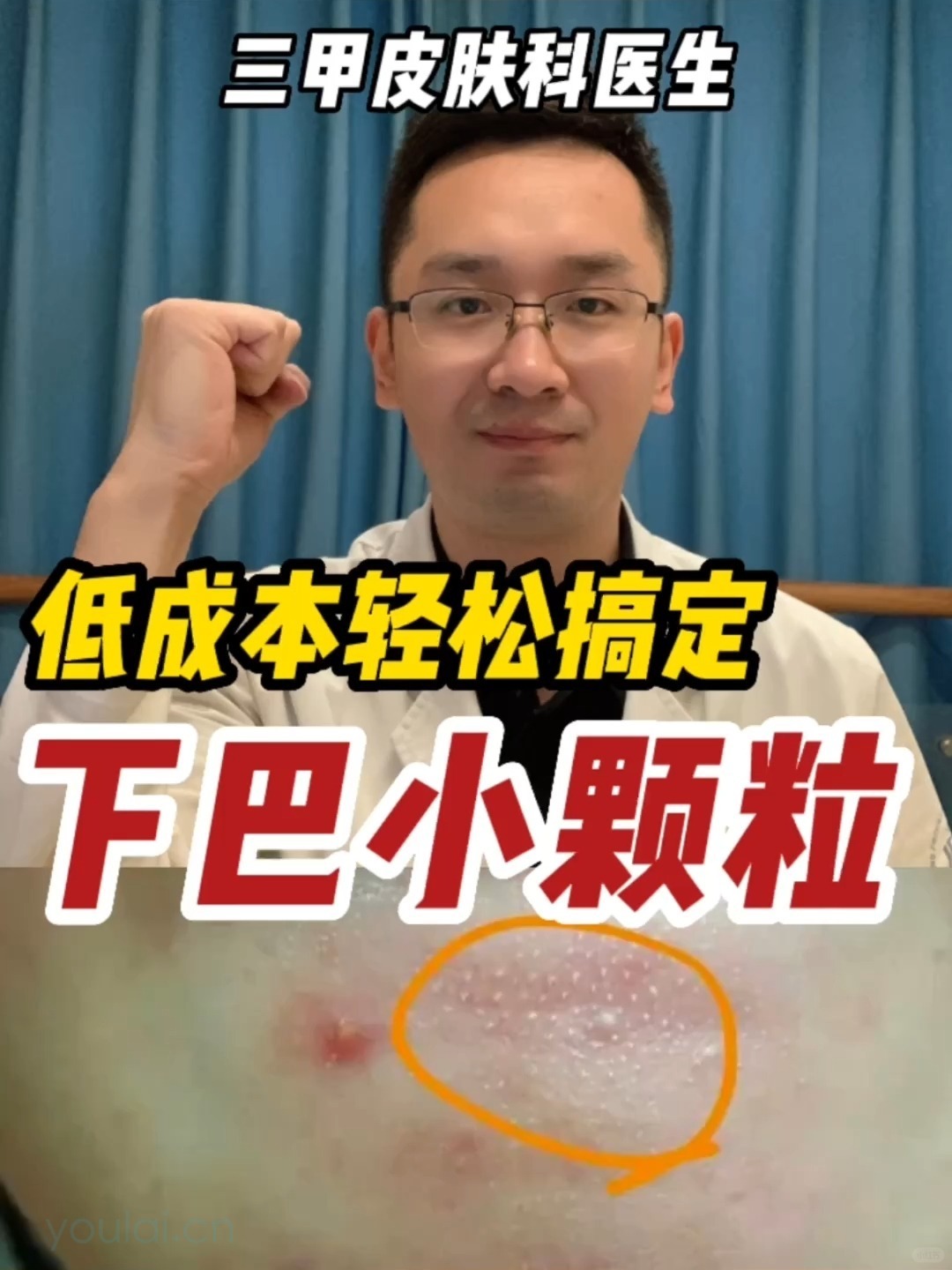 十幾塊錢搞定下巴小顆粒！