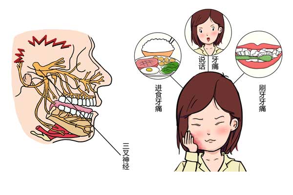 插画2三叉神经痛引起的牙痛600400.jpg