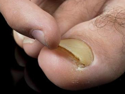 jpeg 甲分离脚趾甲与甲床分离后增厚发黄图.jpeg