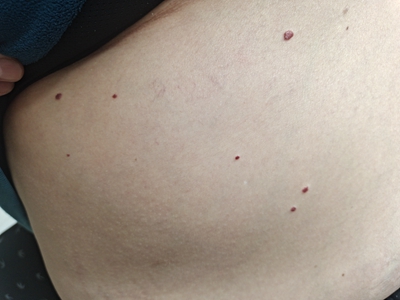 jpeg 樱桃状血管瘤腹部有很多小红点图.jpeg