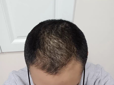 雄激素性脱发症状图片