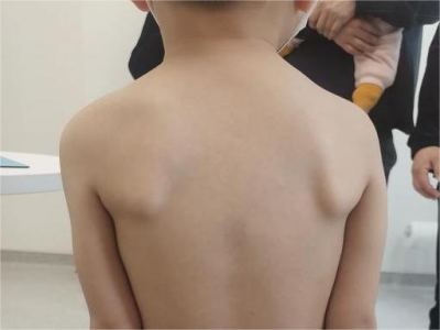 png 先天性高肩胛症肩胛骨向外倾斜图.png