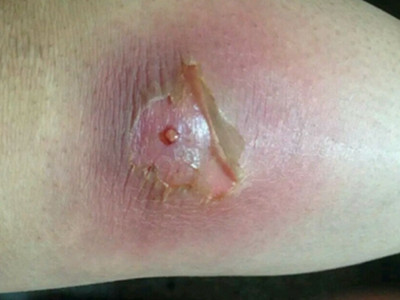 jpeg 痈大腿红肿顶部脓液渗出图.jpeg