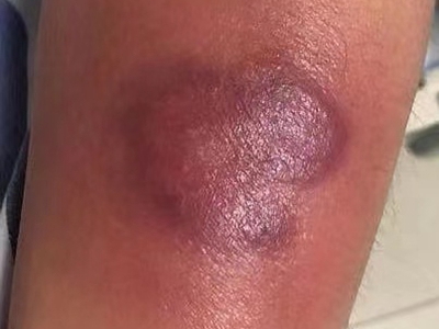 jpg 坏疽性蜂窝织炎腿部红斑图.jpg