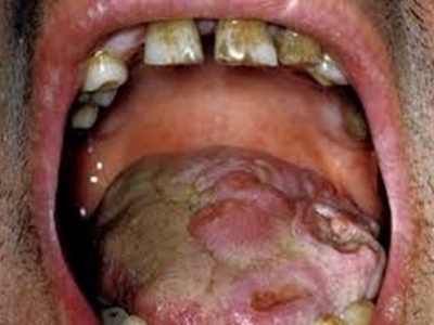 jpg 三期口腔梅毒舌头有很多溃疡图.jpg
