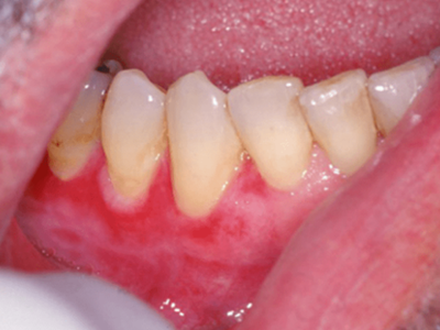 png 增殖性红斑牙龈有不规则红斑图.png