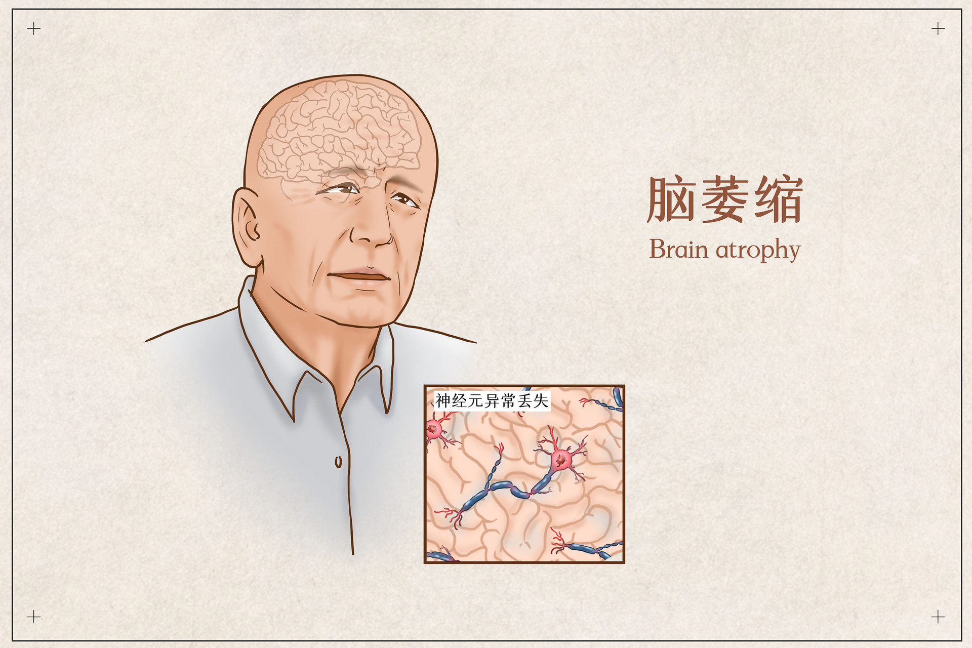 脑萎缩.jpg