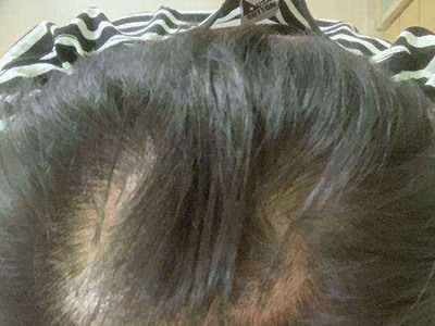 头发脱发少毛症头顶头发脱落图少毛症患者青春期头发开始弥漫性脱落，脱