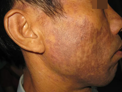 jpg 皮肤黑变病右脸有大片褐黑色斑块图.jpg