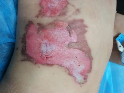 jpg 二度烫伤肚子上红白交加破皮图.jpg