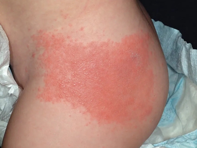 jpg 皮肤过敏红肿大腿外侧红斑小水疱图.jpg