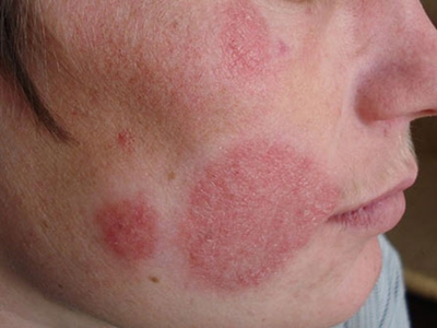 jpg 面癣脸上好几块圆形红斑图.jpg