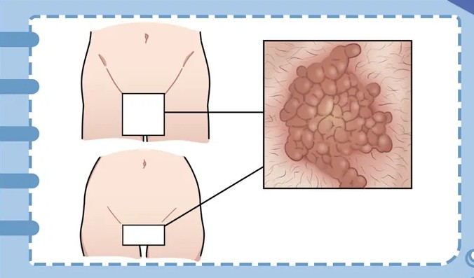 女人器官尖銳濕疣圖片