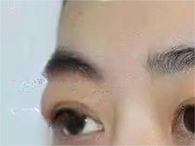 jpeg 泪腺脱垂上眼皮肿胀外突图.jpeg