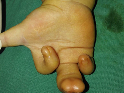 jpg 狭颅症手指两根合成一根图.jpg