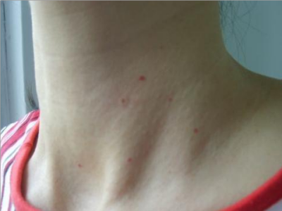 png 樱桃状血管瘤脖子小红点图.png