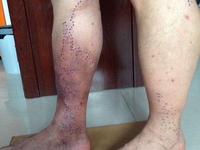 jpg 游走性血栓性静脉炎小腿出现大片红斑图.jpg