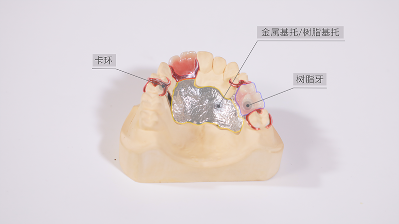 png 可摘局部义齿.png