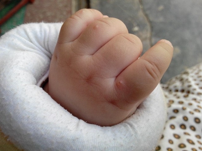 jpg 婴儿肢端脓疱病手指上长小疙瘩图.jpg