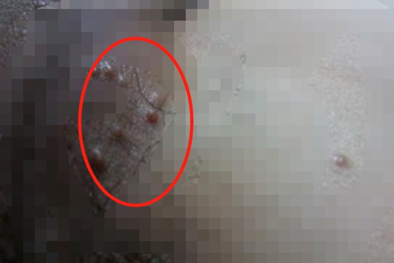男人尿道口尖銳濕疣的早期癥狀圖片