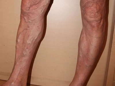 jpg 游走性血栓性静脉炎小腿长结节和条索图.jpg