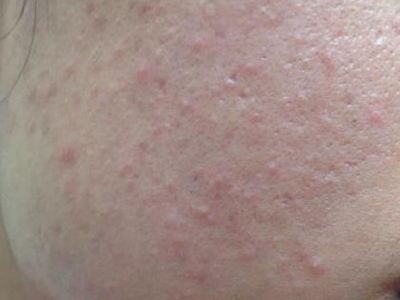 jpeg 痤疮早期图.jpeg