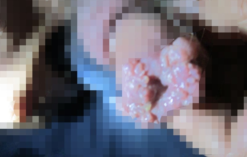 男人假尿道口尖銳濕疣圖片