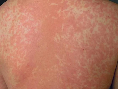 jpg 脓毒败血症疹背部起大片红疹图.jpg