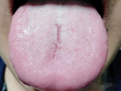 jpg 裂纹舌舌头中间一条沟状竖纹图.jpg