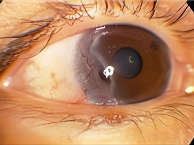jpg 蚕蚀性角膜溃疡黑眼球一侧有一层白斑图.jpg