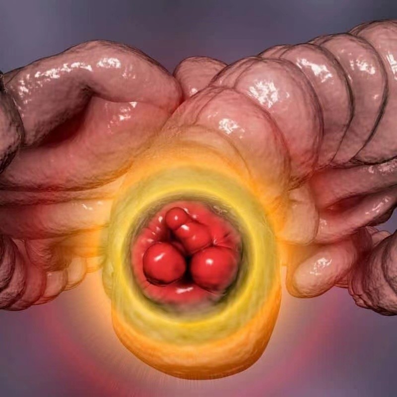 痔瘡?fù)庵痰陌Y狀圖片 (6)