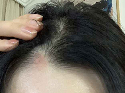 jpg 拔毛癖前额头皮发红图.jpg