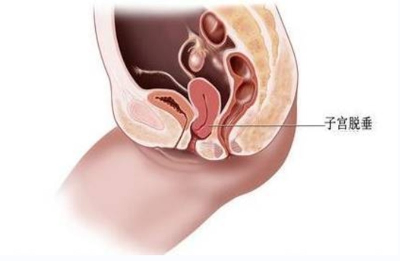 子宮脫垂和痔瘡都要割圖片
