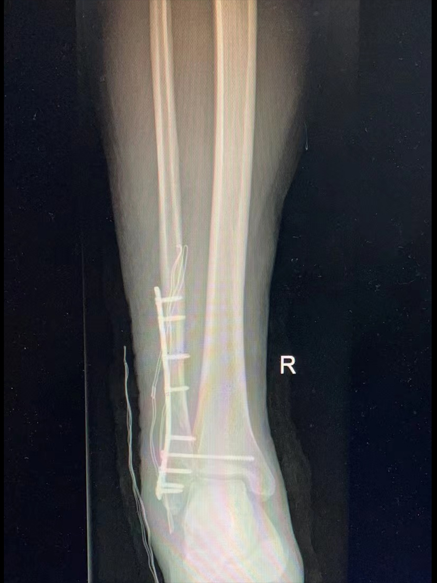 腓骨骨折04.jpg